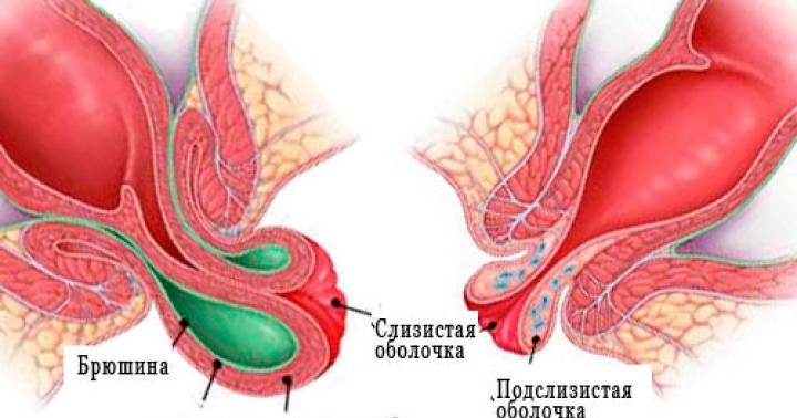 Prolapso rectal en mujeres, niños, hombres - causas, tratamiento, grados