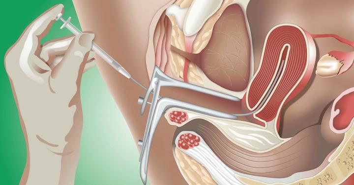 Metode de inseminare artificiala: indicatii, conduita si preturi