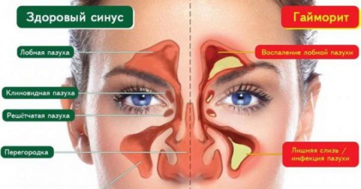 How to cure a lingering rhinitis in an adult Lingering rhinitis